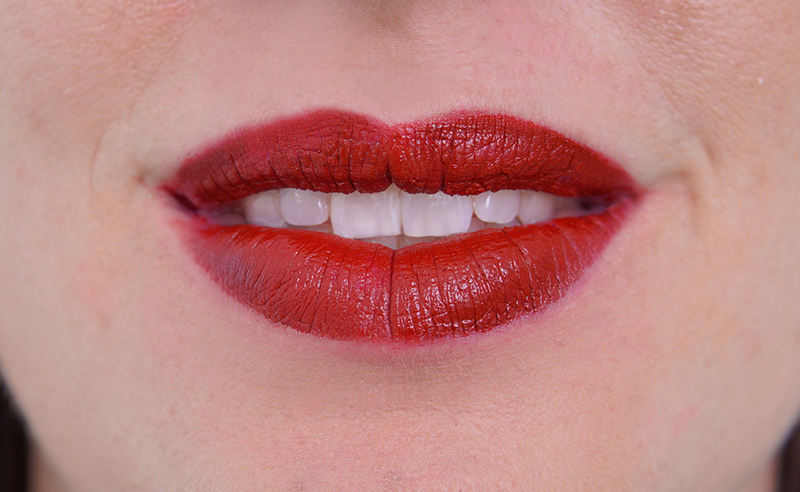 Labios ácido hialurónico