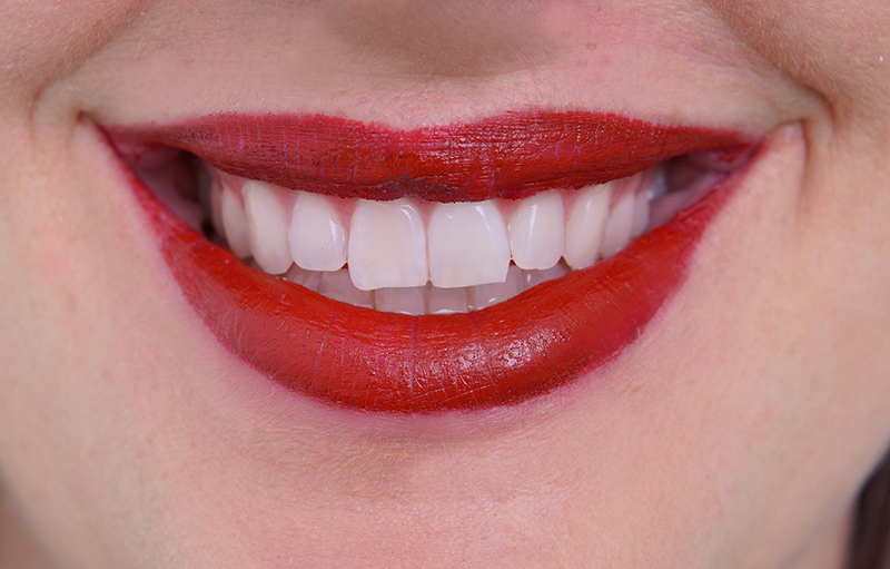 Labios ácido hialurónico