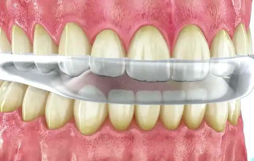 Dentadura servicio bruxismo