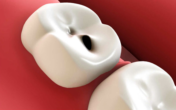caries-en-niños