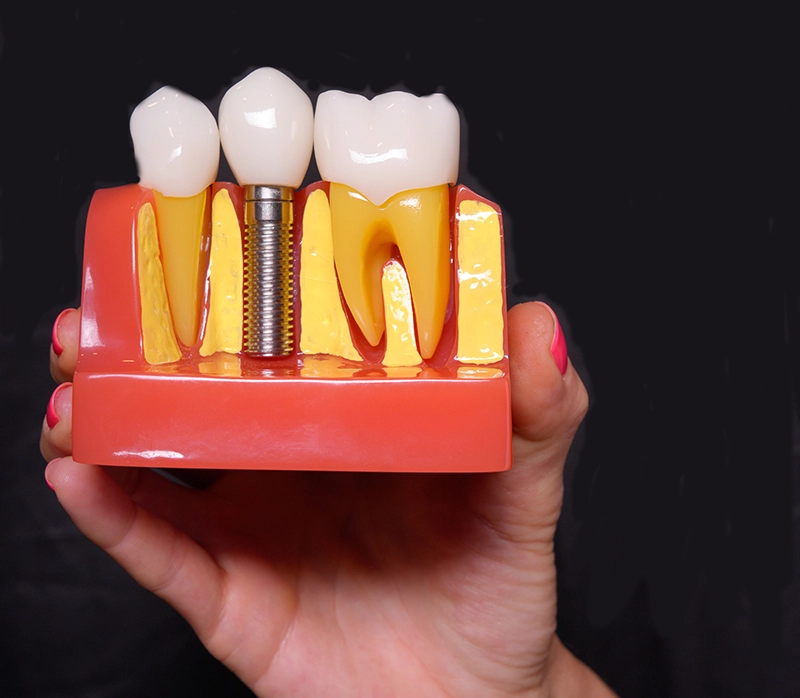 Mano sujetando dentadura con implante