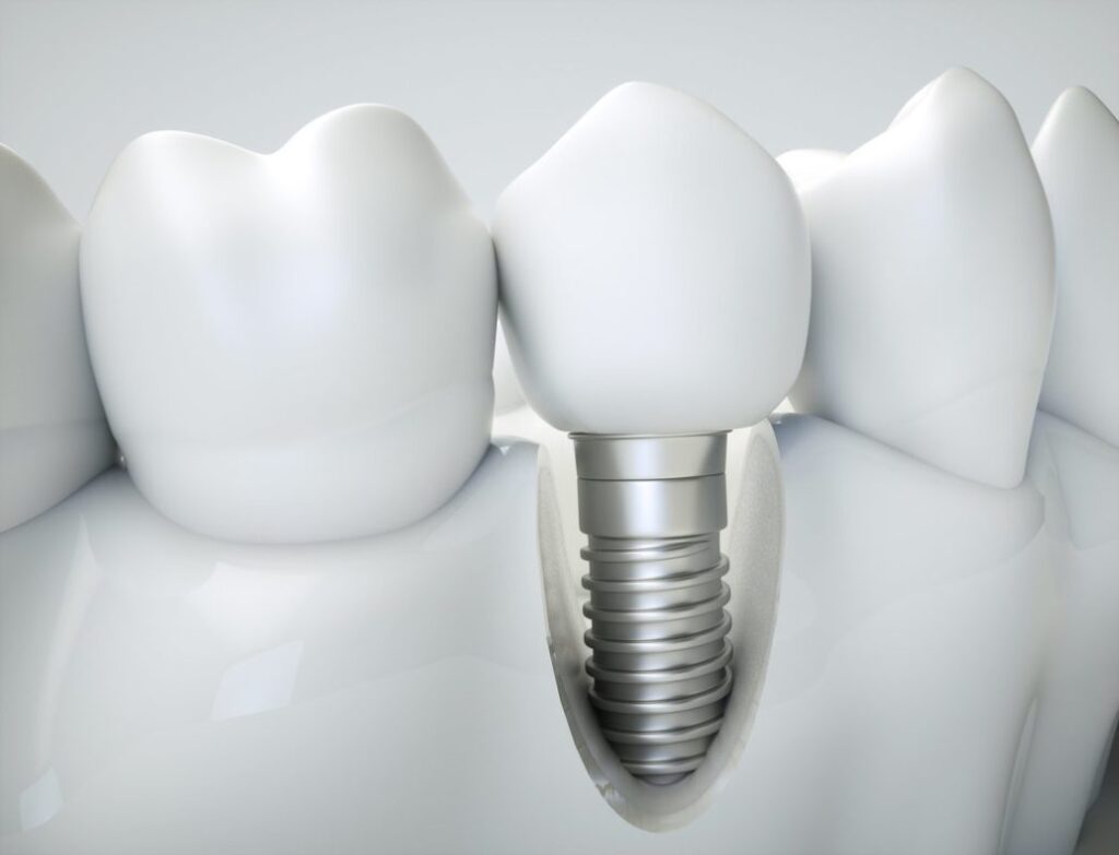 implantes-dentales-en-madrid-1030x788