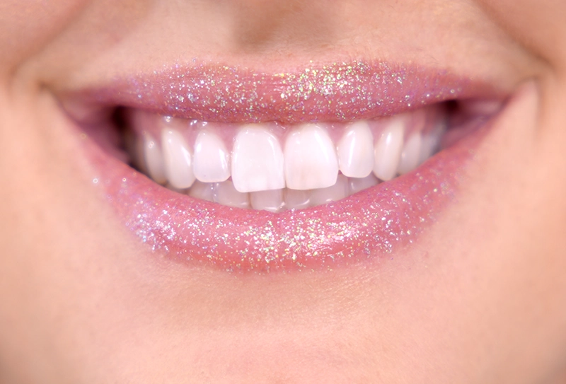 Sonrisa con labios rosa de ácido hialurónico